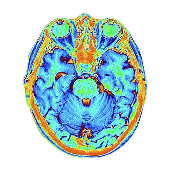 Scientific Imaging Poster featuring the photograph Coloured Mri Scan Of The Human Head #8 by Alfred Pasieka/science Photo Library