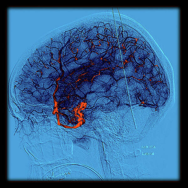 Abnormal Cerebral Arteriogram Poster featuring the photograph Enhanced Temporal Lobe Hemorrhage #9 by Living Art Enterprises, LLC
