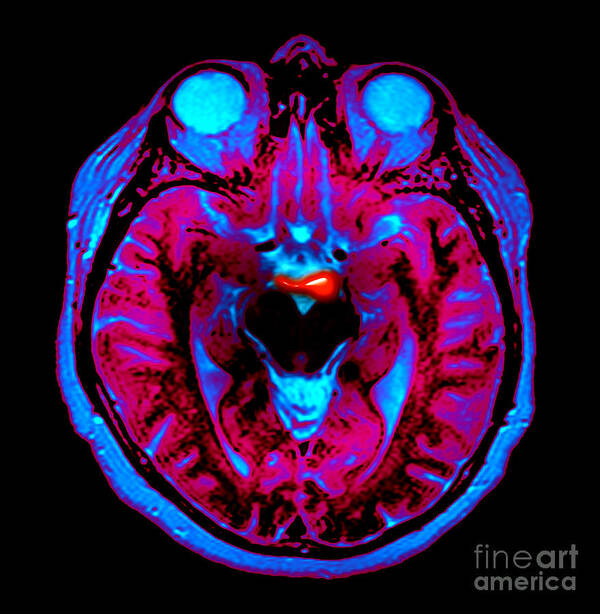 Mri Poster featuring the photograph Basilar Artery Aneurysm, Mri by Living Art Enterprises