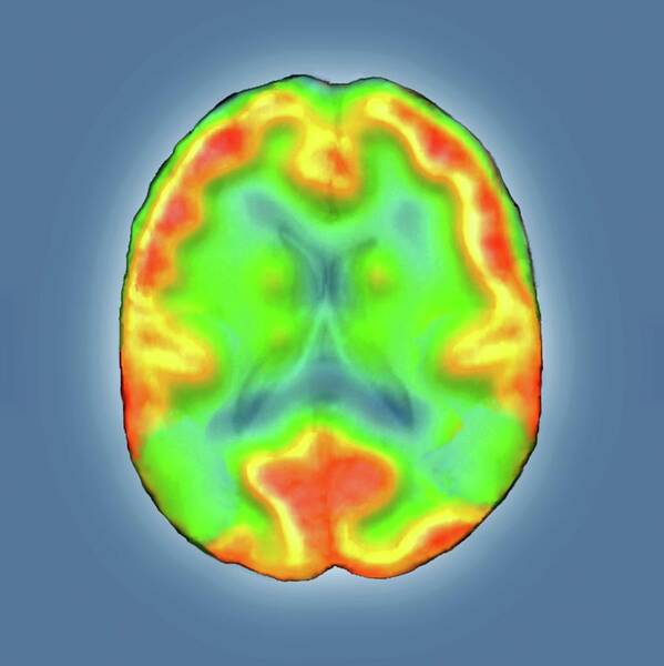 Black Background Poster featuring the photograph Brain In Alzheimer's Disease by Zephyr/science Photo Library