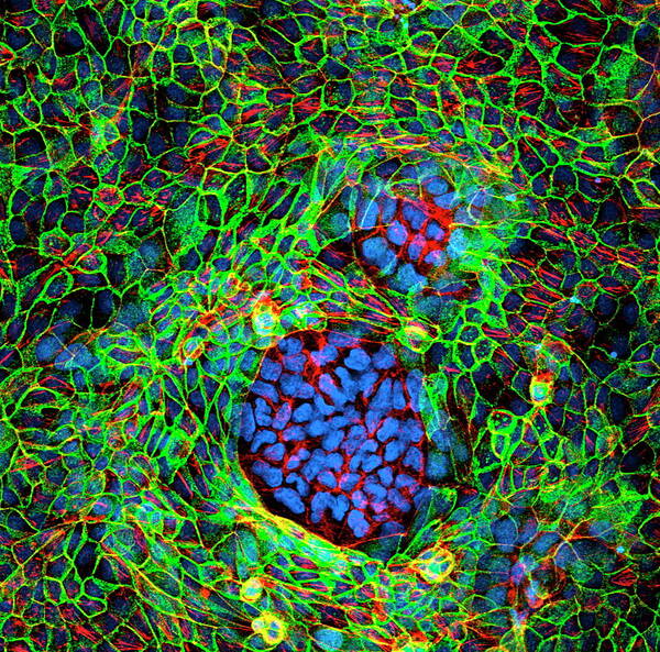 Tumour Poster featuring the photograph Cancer Cells by 