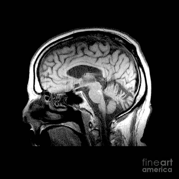 Mri Of Brain Poster featuring the photograph Mri Of Alcoholism Related Vermian #1 by Medical Body Scans
