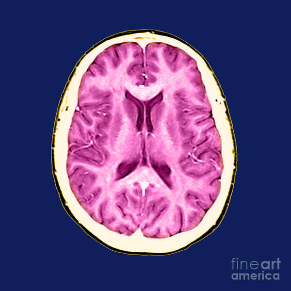 Anatomical Poster featuring the photograph Normal Cross Sectional Mri Of The Brain #1 by Medical Body Scans