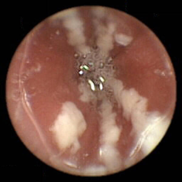 Candida Albicans Poster featuring the photograph Oesophageal Candidiasis, Pill Camera View #1 by David M. Martin, Md