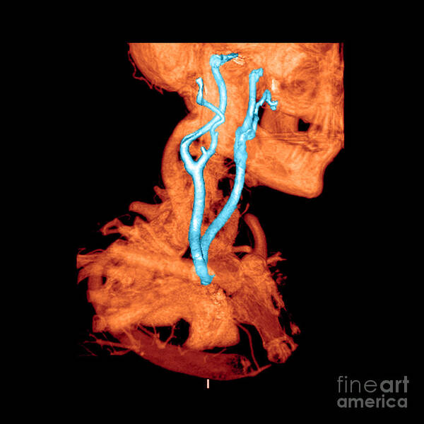 3 Dimensional Poster featuring the photograph 3d Cta Of Carotid Arteries #2 by Medical Body Scans