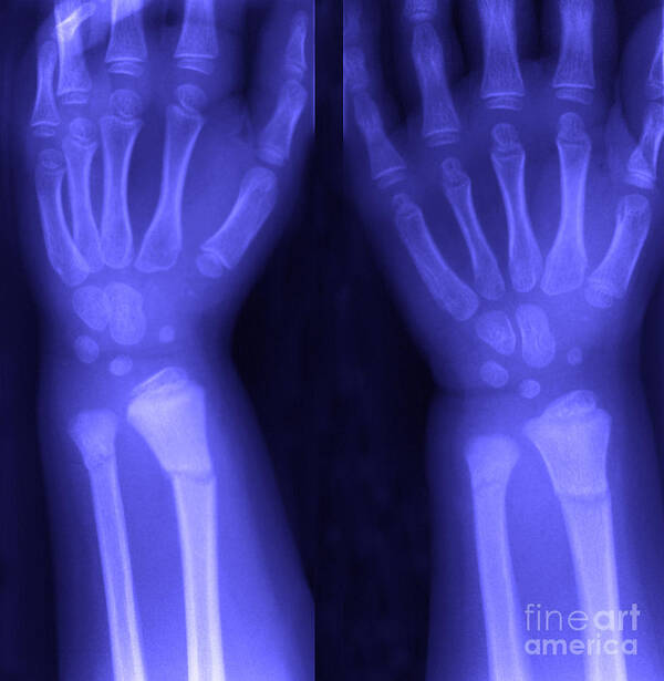 X-ray Poster featuring the photograph Broken Wrist #3 by Ted Kinsman