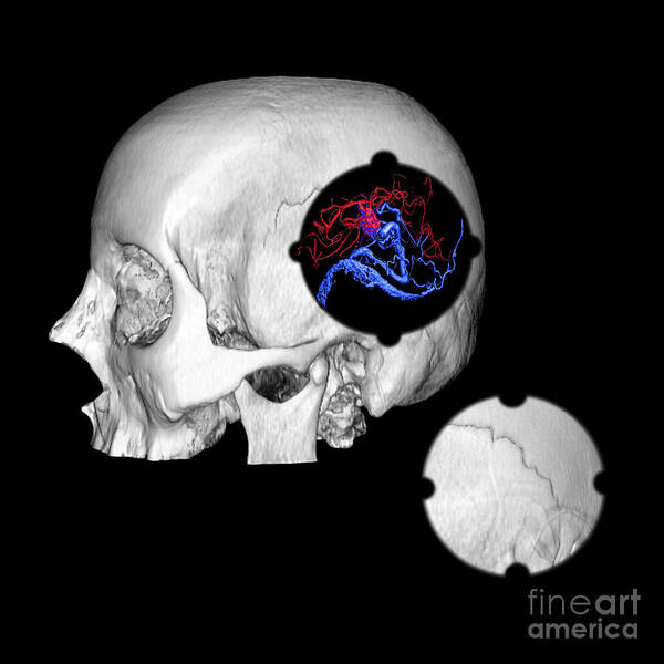 3d Ct Reconstruction Poster featuring the photograph 3d Color Enhanced Image Of Skull And Avm by Medical Body Scans