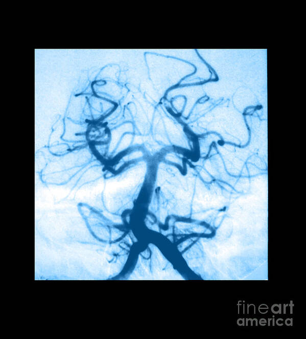 Abnormal Cerebral Angiogram Poster featuring the photograph Angiogram Of Embolus In Cerebral Artery by Medical Body Scans