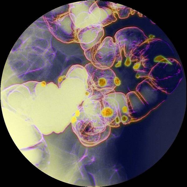 Diverticular Disease Poster featuring the photograph Diverticular Disease, X-ray by Du Cane Medical Imaging Ltd