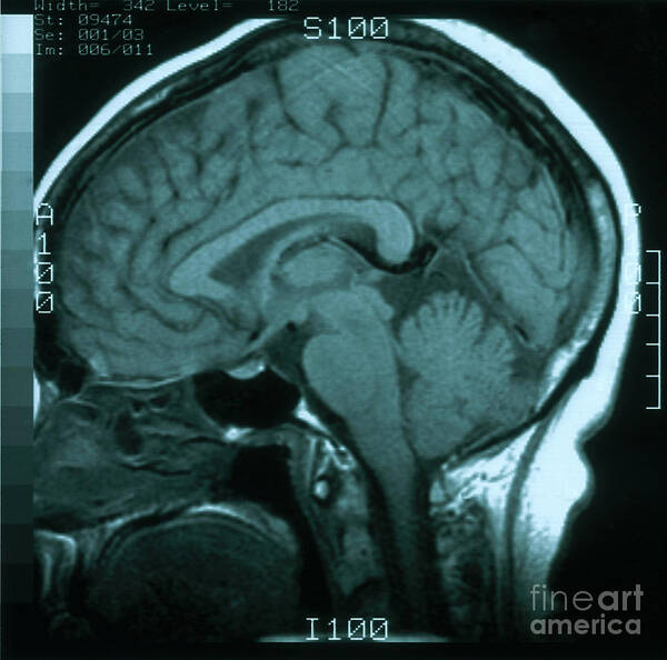 Brain Poster featuring the photograph Mri Of Normal Brain #2 by Science Source