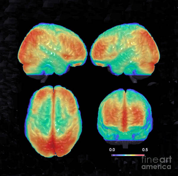 Science Poster featuring the photograph Bipolar Brain, 3d Mri Scan by Science Source