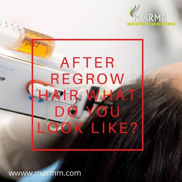 After Regrow Hair What Do You Look Like? Poster by Marmm Clinic - Fine Art  America