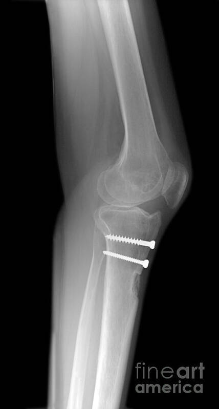 Artificial Implant Art Print featuring the photograph Knee Joint by Ted Kinsman