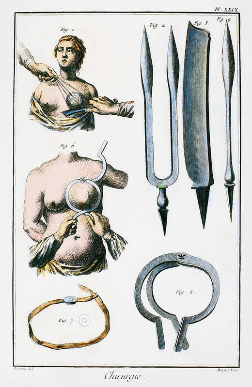 18th Century Art Print featuring the drawing Breast Surgery #1 by Granger