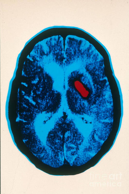 Ct Scan Art Print featuring the photograph Hemorrhagic Stroke, Ct Scan by Scott Camazine