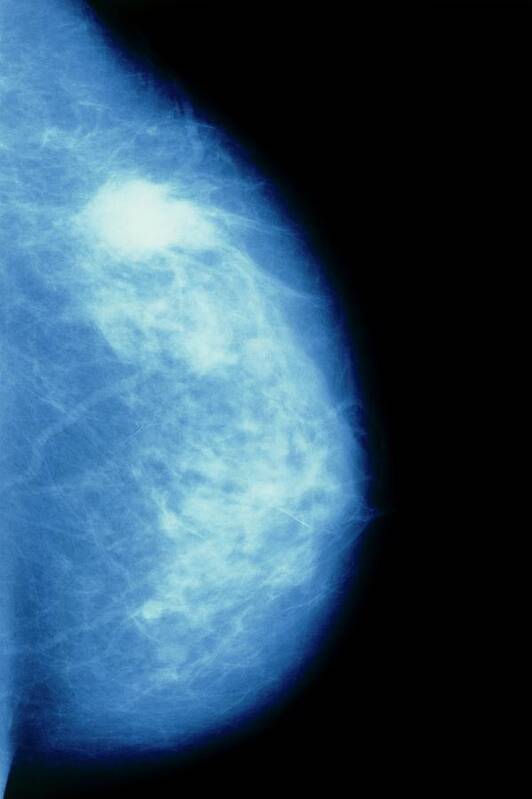 Mammogram Art Print featuring the photograph Mammogram Of Breast Showing Cancerous Tumour by Breast Screening Unit, Kings College Hospital, London/science Photo Library