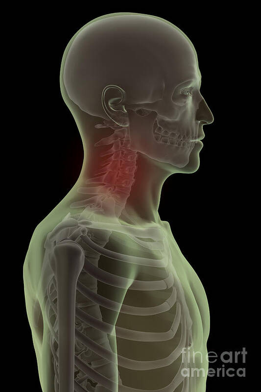 Joint Art Print featuring the photograph Neck Pain by Science Picture Co