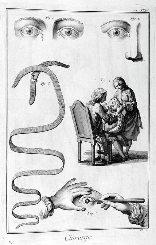 Engraving Art Print featuring the drawing Eye Surgery, 1751-1777 by Print Collector