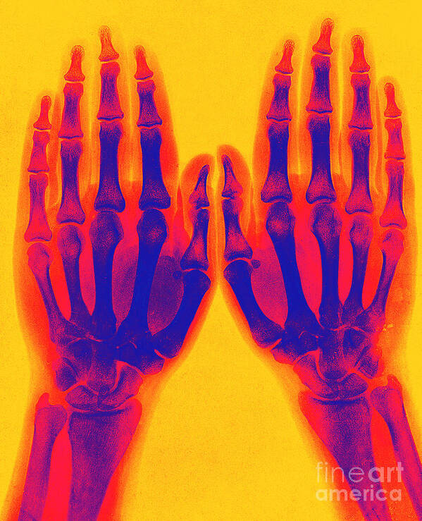 Historic Art Print featuring the photograph X-ray Of Two Normal Hands 1896 #3 by Science Source