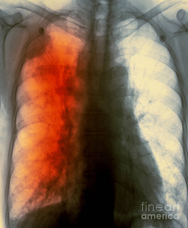 Scan Art Print featuring the photograph Lung Cancer X-ray #2 by Scott Camazine