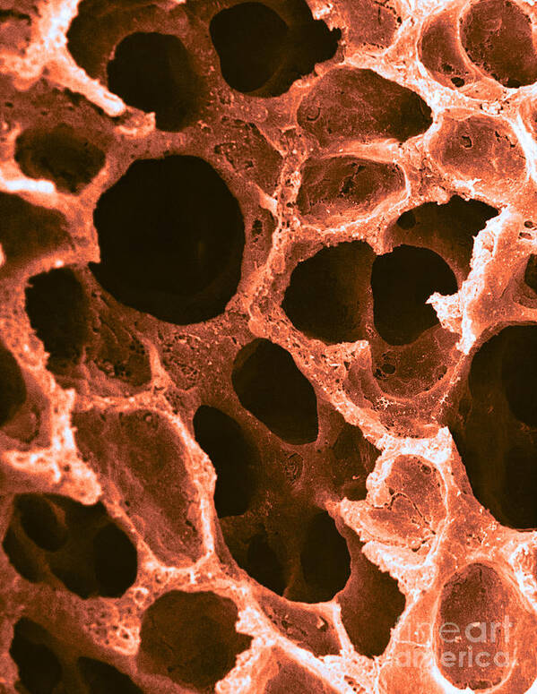 Science Art Print featuring the photograph Alveoli In Lung, Sem by David M. Phillips