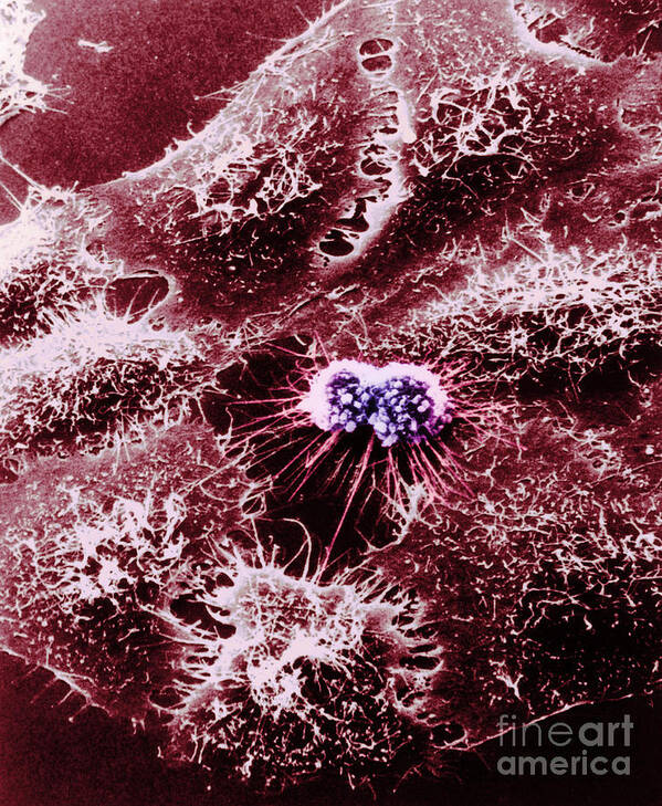 Adenovirus Art Print featuring the photograph Hela Cells With Adenovirus #2 by Science Source