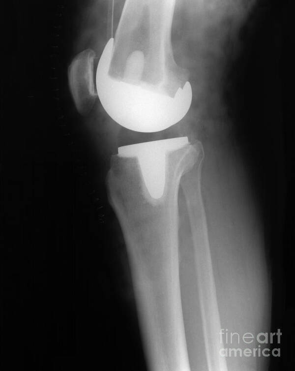 Xray Art Print featuring the photograph Knee Replacement X-ray #5 by Ted Kinsman