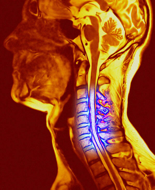 Cervical Vertebra Art Print featuring the photograph Osteochondrosis Of The Neck Bones by Pasieka
