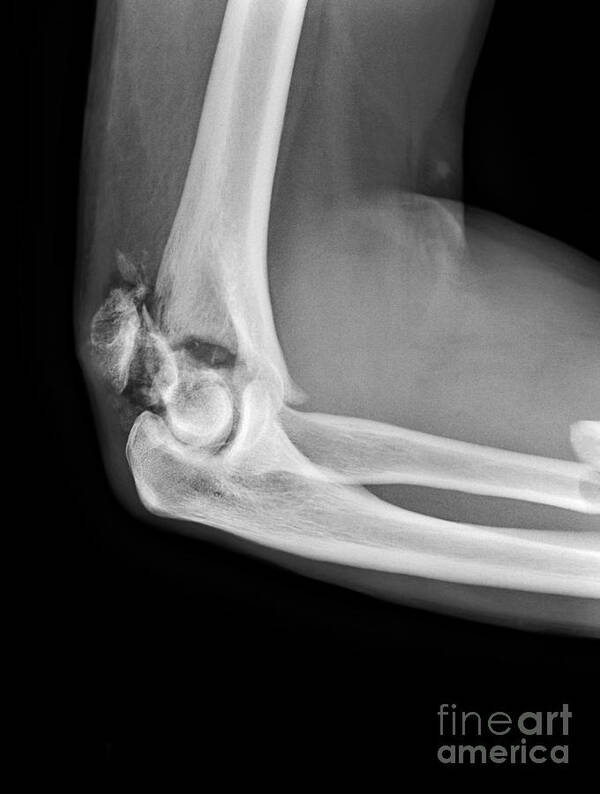 Fracture Art Print featuring the photograph Broken Elbow, X-ray #1 by Science Photo Library
