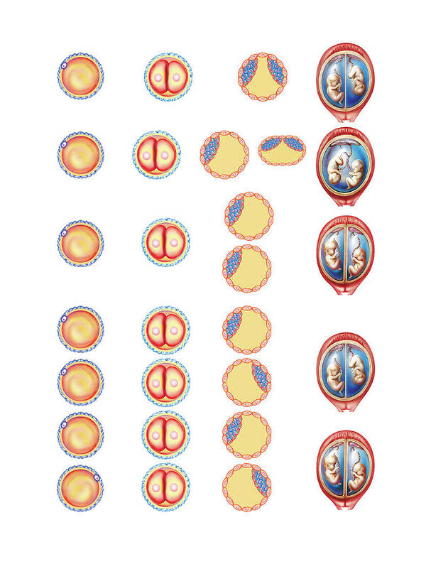 Anatomical Art Print featuring the photograph Types Of Twin #1 by Asklepios Medical Atlas