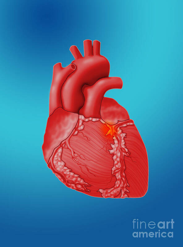 Science Art Print featuring the photograph Heart Attack, Conceptual Illustration #4 by Monica Schroeder
