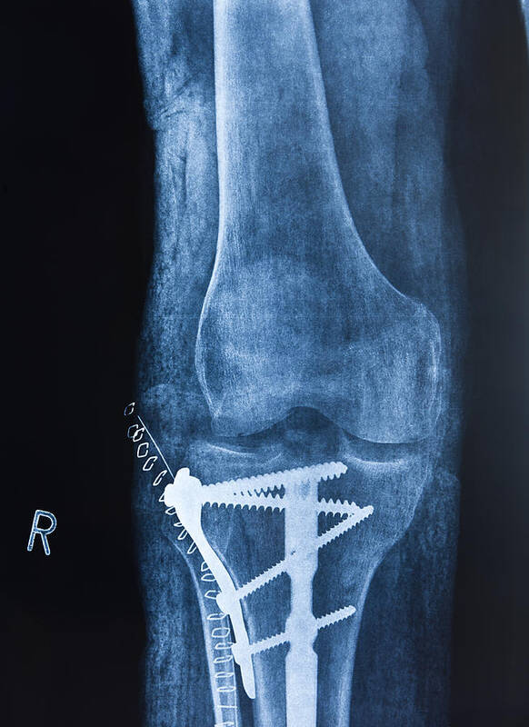 Broken Leg Art Print featuring the photograph Broken leg by Pedre