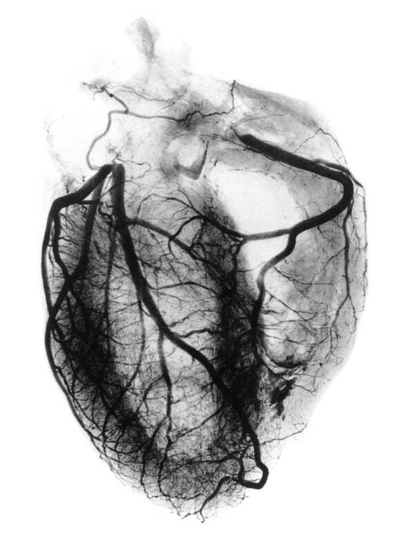 Black-and-white Art Print featuring the photograph Coronary Arteriogram Of Arteries Of The Heart 1904 by Science Photo Library