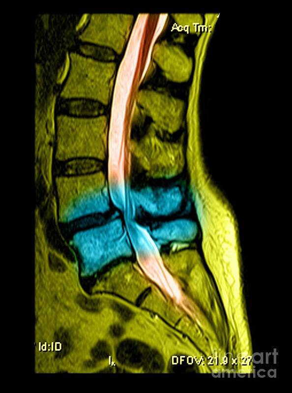 Anatomy Art Print featuring the photograph Spondylolisthesis and Canal Stenosis by Medical Body Scans