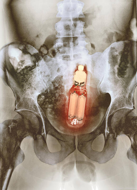 Sex Toy In Man S Rectum X Ray Art Print By Du Cane Medical Imaging Ltd
