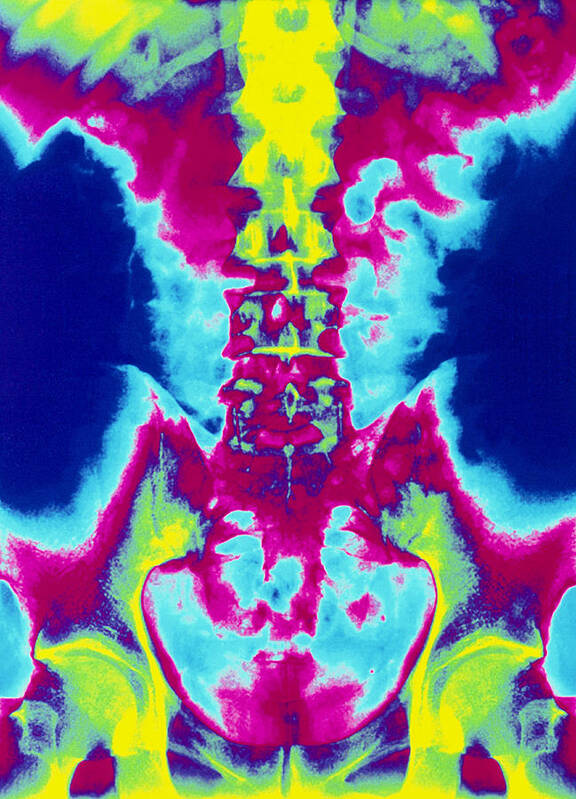 Spine Art Print featuring the photograph Coloured X-ray Of Normal Lumbar Spine (lower Back) #1 by Mehau Kulyk