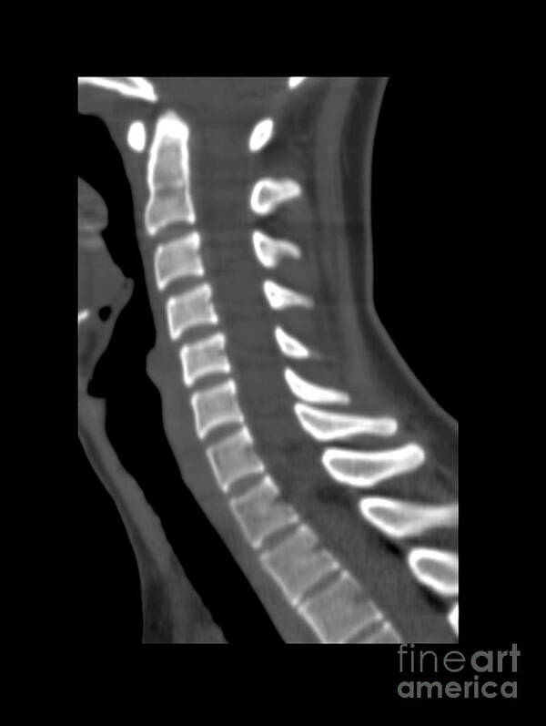 Medical Art Print featuring the photograph Normal Cervical Spine by Medical Body Scans