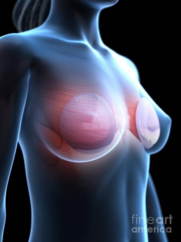 3d Art Print featuring the photograph Breast Implants #10 by Sebastian Kaulitzki/science Photo Library
