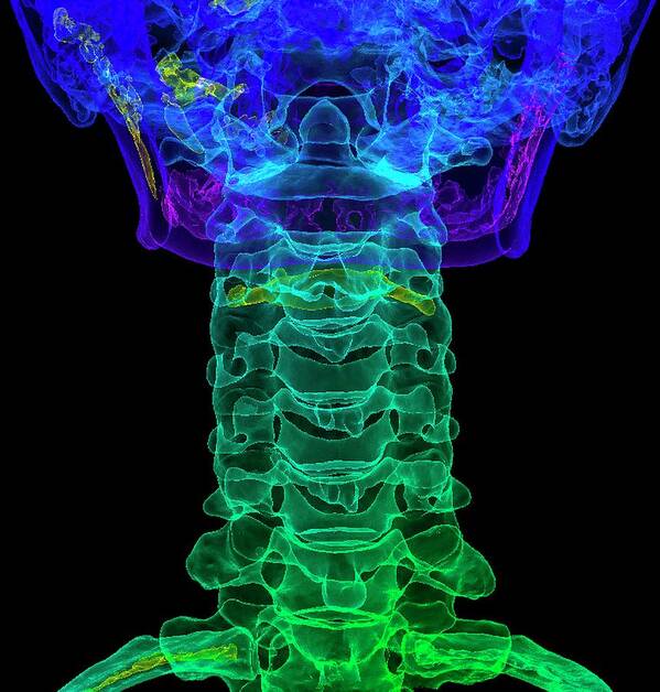 Bone Art Print featuring the photograph Cervical Spine Anatomy by K H Fung/science Photo Library