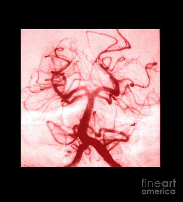 Abnormal Cerebral Angiogram Art Print featuring the photograph Angiogram Of Embolus In Cerebral Artery #2 by Medical Body Scans