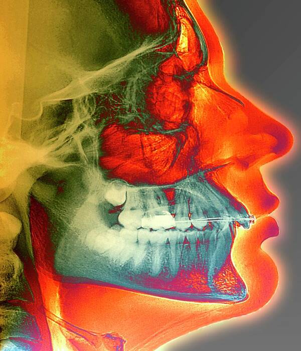 Orthodontic Art Print featuring the photograph Orthodontic Brace X-ray by Zephyr/science Photo Library