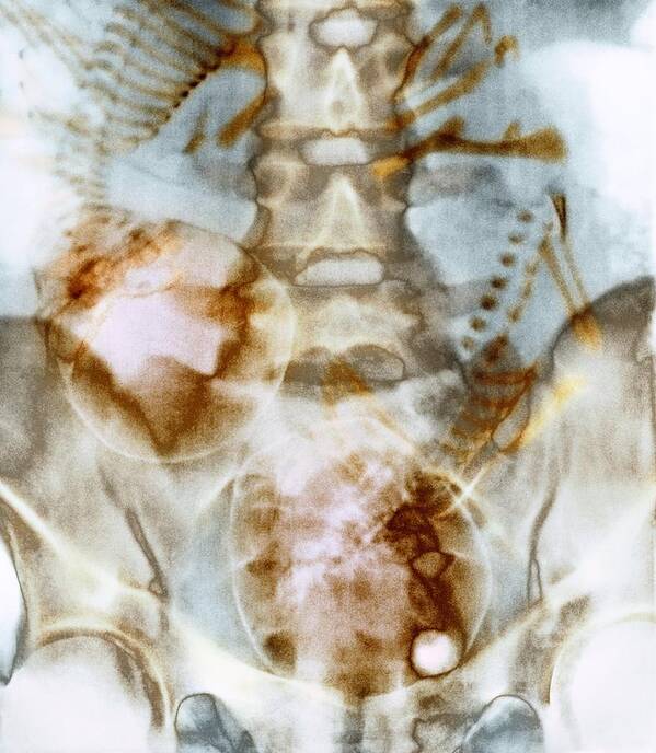 42 Week Old Art Print featuring the photograph Full-term Foetus Twins, X-ray #1 by David Parker