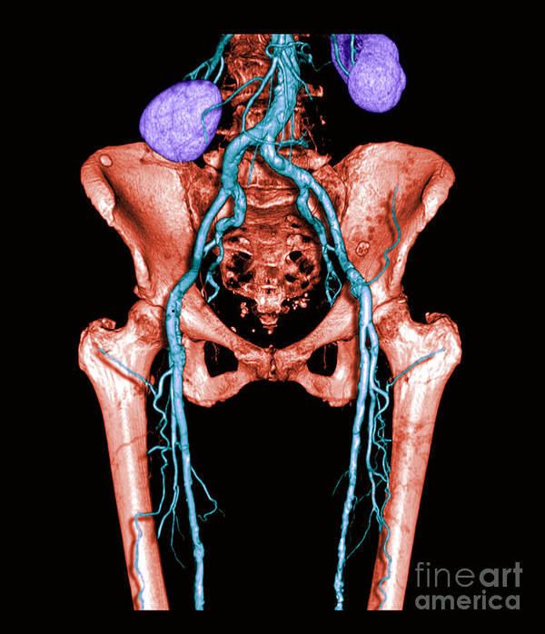 Anatomy Art Print featuring the photograph Pelvis And Upper Legs #2 by Medical Body Scans