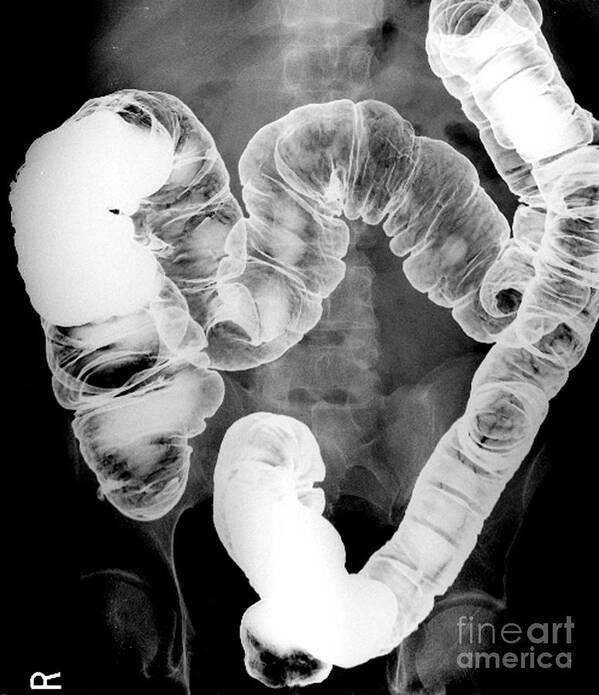 Intestine Art Print featuring the photograph Normal Double Contrast Barium Enema #8 by Medical Body Scans