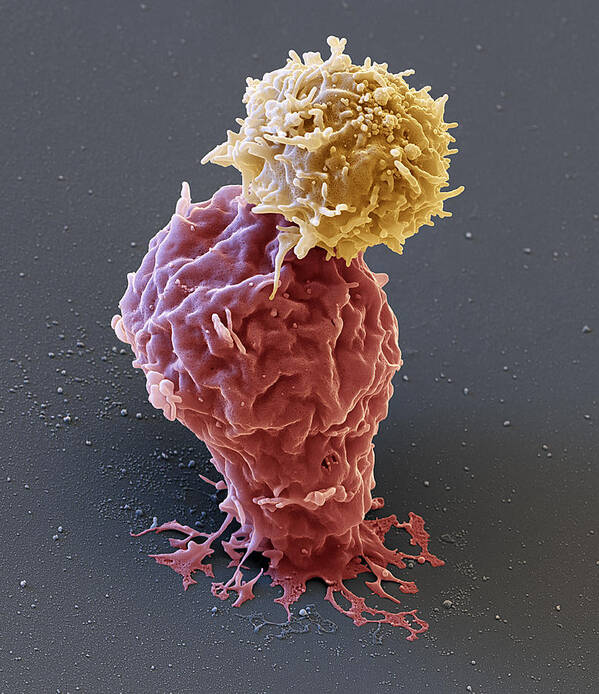 Attacks Leukemia Art Print featuring the photograph Leukemia Cell With Car T-cell, Sem #1 by Oliver Meckes EYE OF SCIENCE