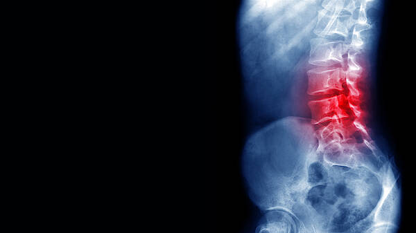 Human Vertebra Art Print featuring the photograph Back pain x-ray by Peter Dazeley