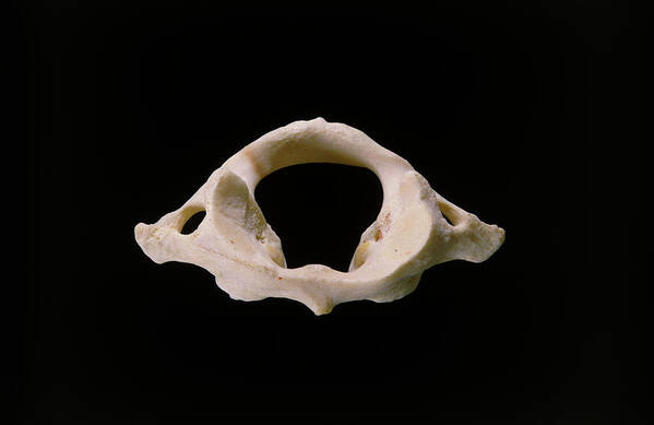 Atlas Bone Art Print featuring the photograph First Cervical (atlas) Vertebra Of Neck by James Stevenson/science Photo Library.