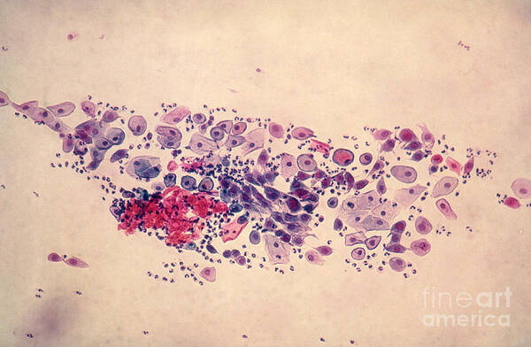 Medical Art Print featuring the photograph Pap Smear, Parabasal Cells by Science Source