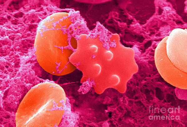 Biology Art Print featuring the photograph Red Blood Cells And Acanthocyte, Sem by Science Source