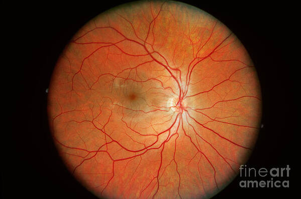 Blood Vessels Art Print featuring the photograph Normal Retina by Science Source